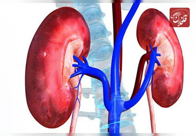 سنگ کلیه شایع ترین بیماری کلیوی در استان آذربایجان شرقی